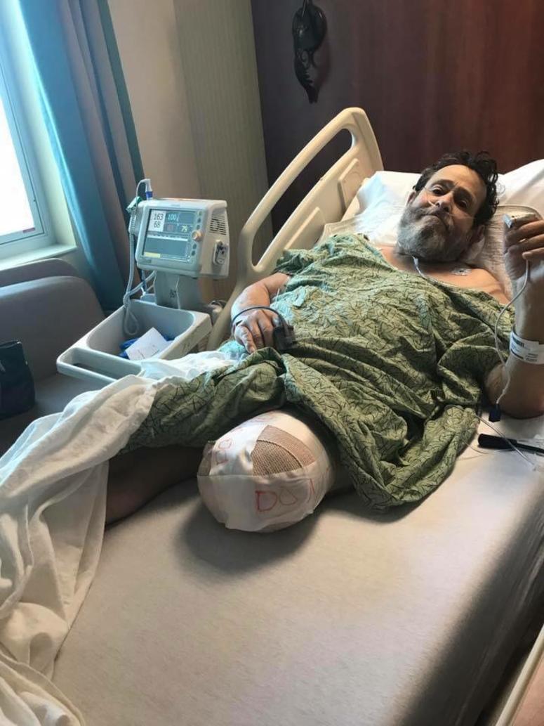 Eddy Rolon shortly after the amputation of his left leg.