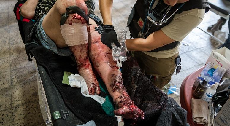 Common Injuries seen in Mosul