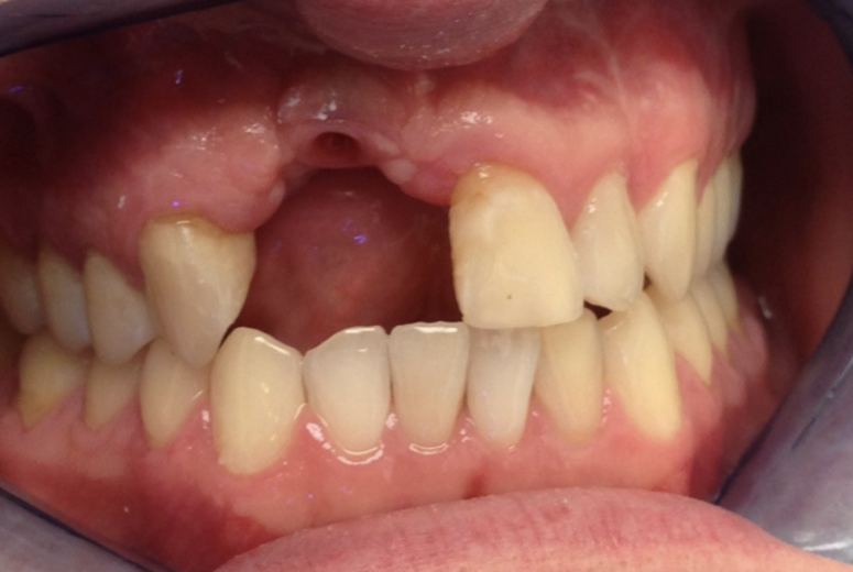 Missing tooth Missing tooth