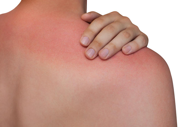 Sunburn, Back, Shoulders Sunburn, Back, Shoulders