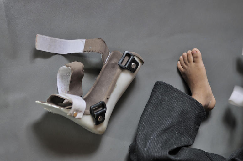 Child, Foot, Cerebral Palsy, Orthopedic Shoe Child, Foot, Cerebral Palsy, Orthopedic Shoe