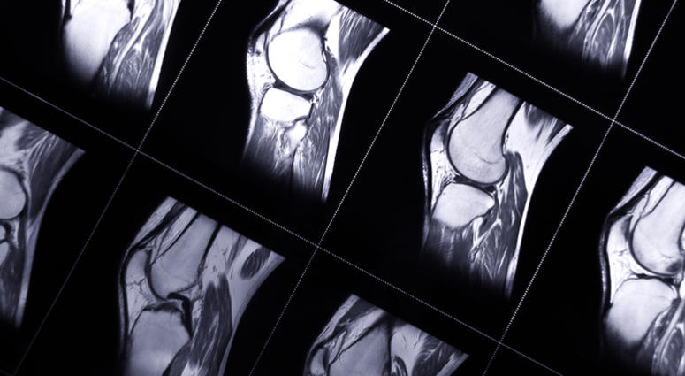 MRI an MRI photo of a joint