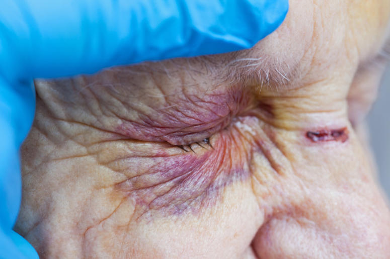 Abuelita Que Paseaba Sus Perritos, Fue Golpeada Por Una Jovencita Elderly woman's injured eye & nurse's fingers