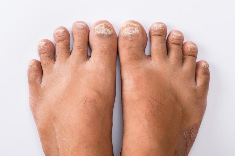 Psoriasis that Pedicure