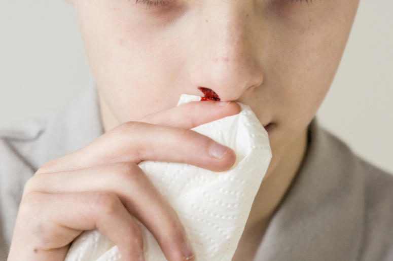 Nosebleed, Tissue, Blood Nosebleed, Tissue, Blood