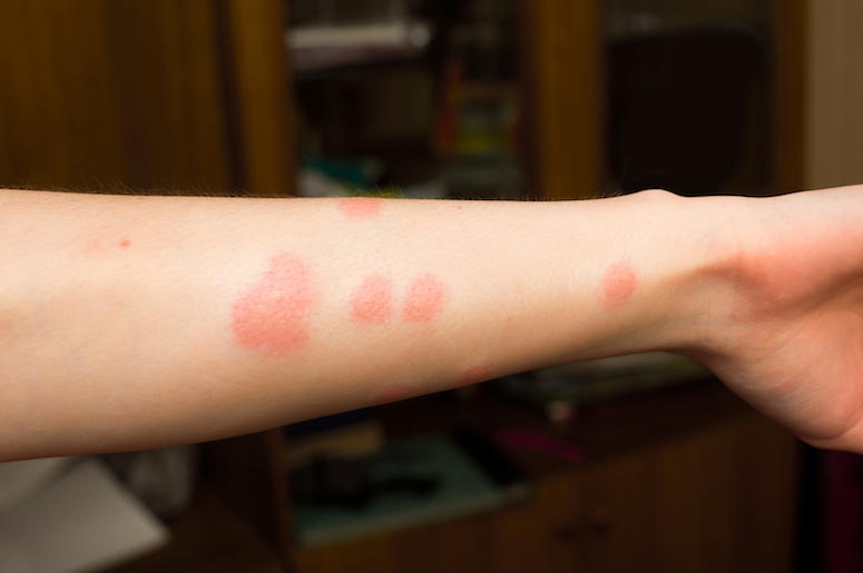 Arm, Bug Bites Arm, Bug Bites