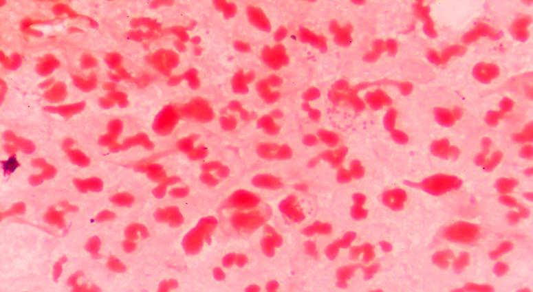 Moderate red white blood cells with gram negative diplococci intracellular.Neisseria gonorrhoeae also known as gonococci , is a species of Gram-negative coffee bean-shaped diplococci bacteria responsible for the sexually transmitted infection gonorrhea Moderate red white blood cells with gram negative diplococci intracellular.Neisseria gonorrhoeae also known as gonococci , is a species of Gram-negative coffee bean-shaped diplococci bacteria responsible for the sexually transmitted infection gonorrhea.