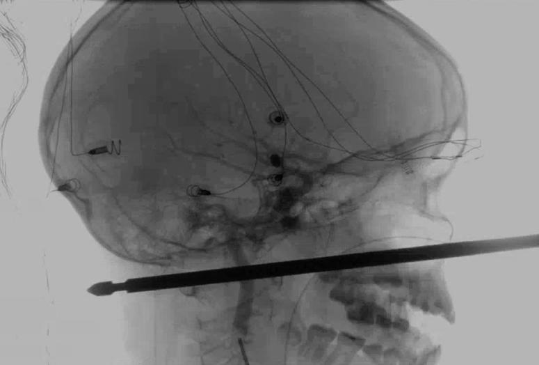 This X-ray provided by the Medical News Network shows a meat skewer impaled in the skull of Xavier Cunningham after an accident at his home Saturday, Sept. 8, 2018, in Harrisonville, Mo. This X-ray provided by the Medical News Network shows a meat skewer impaled in the skull of Xavier Cunningham after an accident at his home Saturday, Sept. 8, 2018, in Harrisonville, Mo.