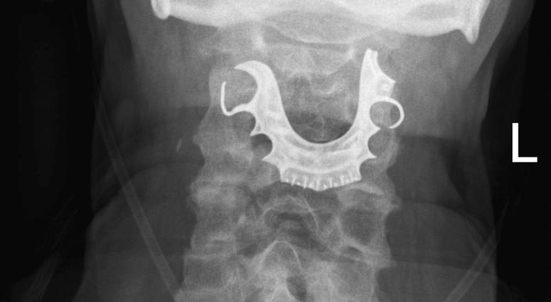 This undated X-ray image provided by the BMJ in August 2019 shows dentures stuck in the throat of a 72-year-old patient. Swallowed dentures