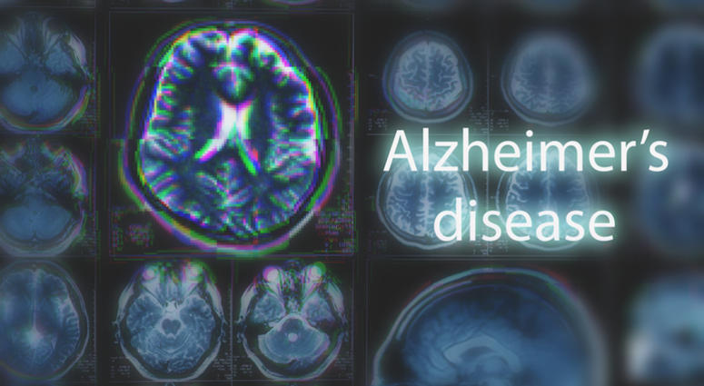 Alzheimer's disease affects more than five million people in the United States. Alzheimer's Disease
