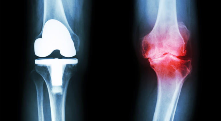osteoarthritis osteoarthritis
