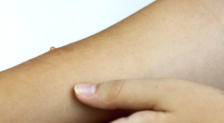 Measles Measles