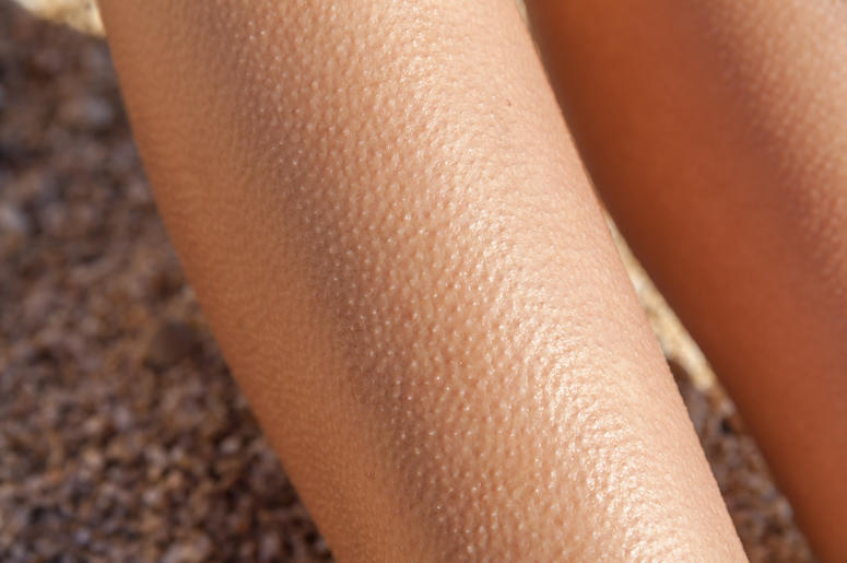 Goosebumps on arm