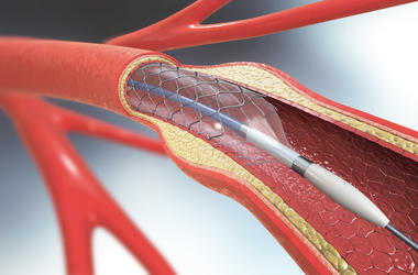 stent stent