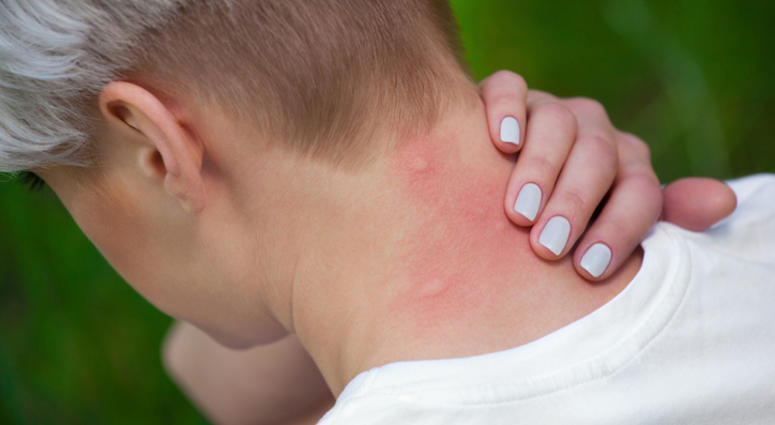 Mosquito bite to the neck Mosquito bite to the neck